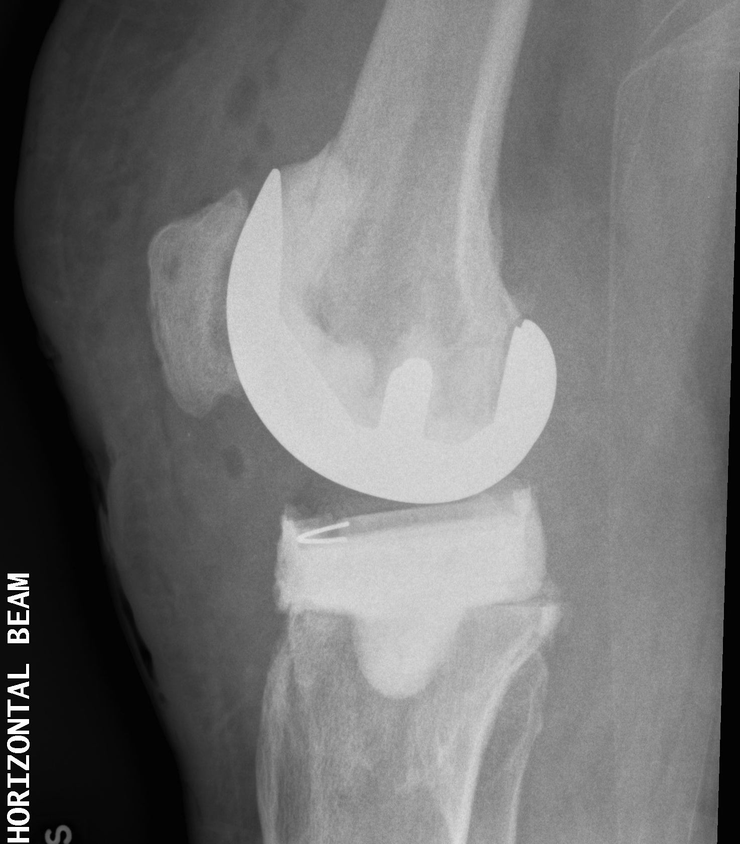Infected TKR Autoclave Femur Cement Tibia Lateral